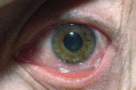 What can be mistaken for eye infection?