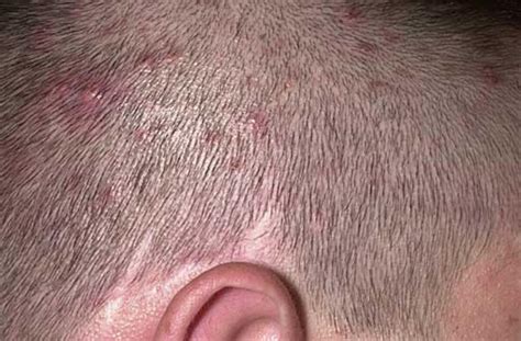 What can be mistaken for folliculitis?
