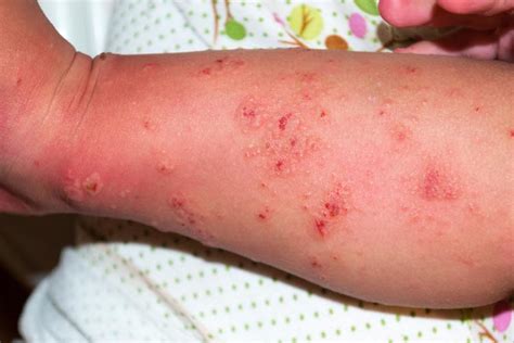 What can be mistaken for scabies?