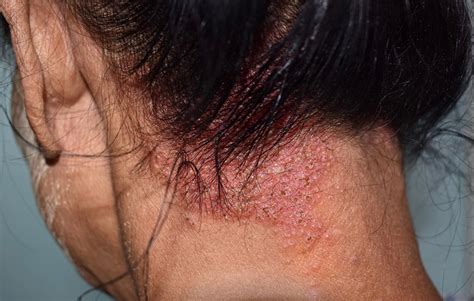 What can be mistaken for seborrheic dermatitis?