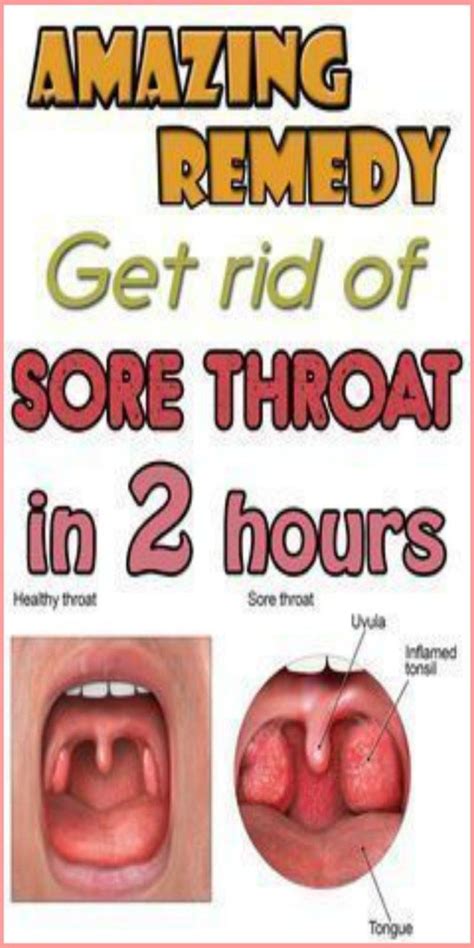 What can cure strep throat fast?