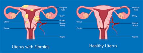 What can damage uterus?