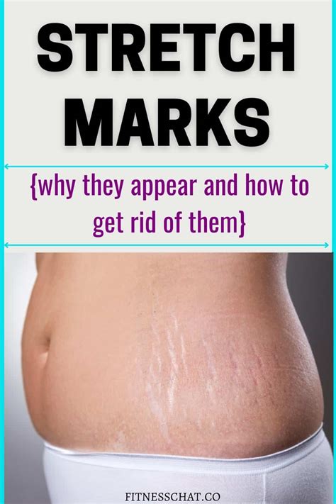 What can remove stretch marks faster?