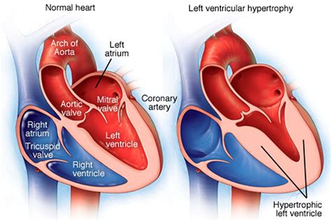 What causes LV?