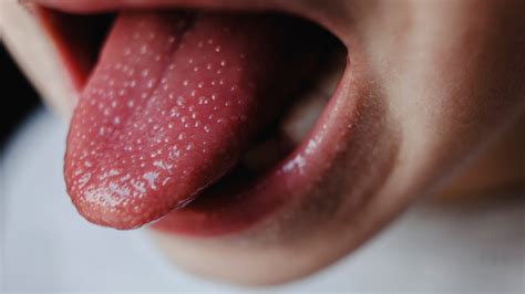 What causes a large tongue?