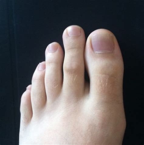 What causes a long second toe?