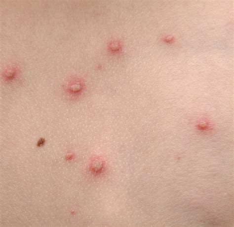What causes a skin virus?