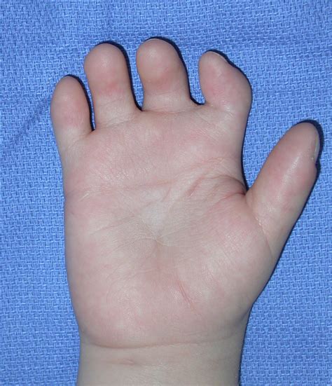 What causes birth defect missing hand?