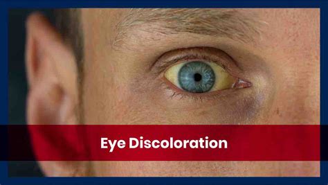 What causes contact lenses to discolor?