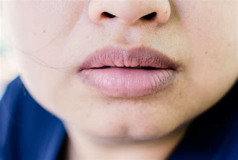 What causes dark lips?
