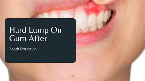 What causes hard bony lump on gum?