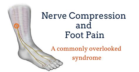 What causes nerve pain in left foot?