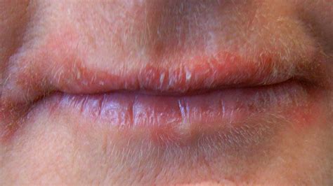 What causes oily lips?