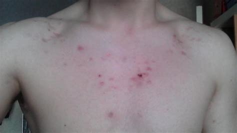 What causes pimples on the chest and back?