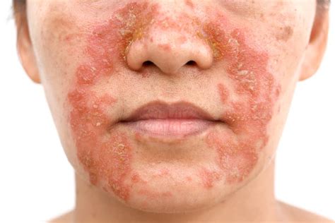 What causes seborrheic dermatitis to flare up on face?