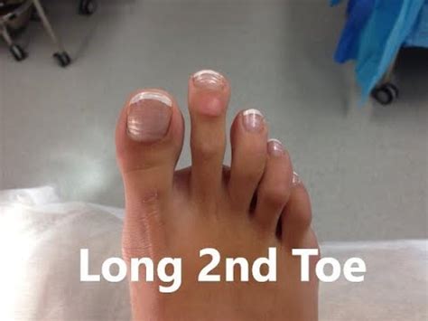 What causes second toe to be longer?