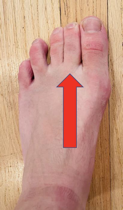 What causes second toe to curl?
