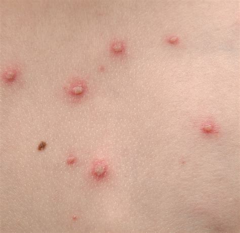 What causes skin virus?