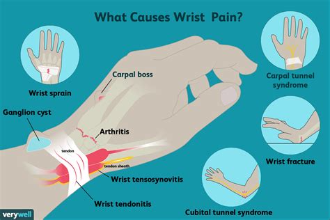 What causes tight wrist?