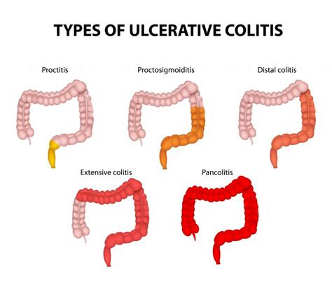 What colon diseases are inherited?