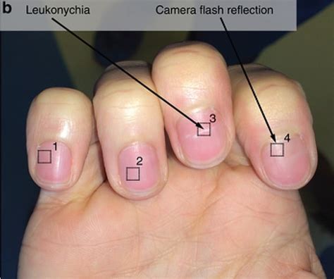 What color are anemia fingernails?