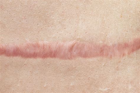 What color are healed scars?