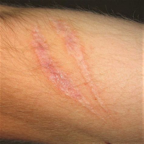 What color are old burn scars?