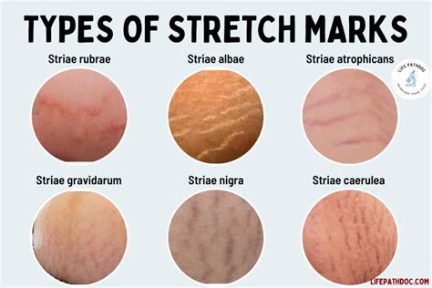What color are stretch marks when you lose weight?