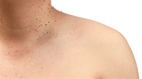 What color does a skin tag turn before it falls off?