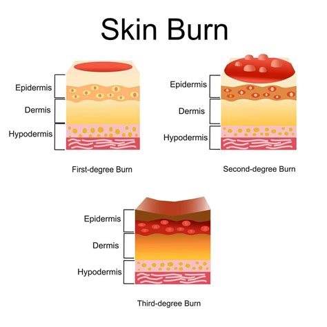 What color is a bad burn?