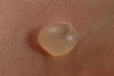 What color is a healthy blister?