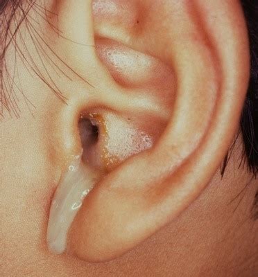 What color is ear infection discharge?