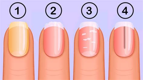 What color is not normal for a healthy nail?