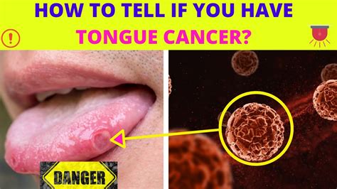 What color is your tongue when you have cancer?
