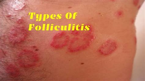 What color pus is folliculitis?