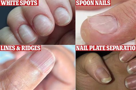 What colour nails are B12 deficiency?