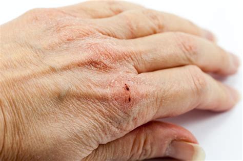 What condition is extremely dry cracked hands?