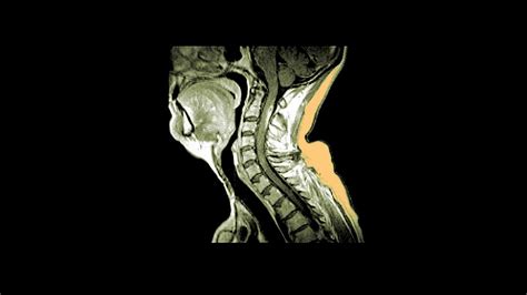 What could an MRI miss?