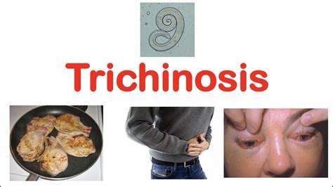 What countries have trichinosis?