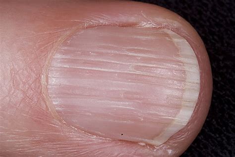 What deficiency causes lines on nails?