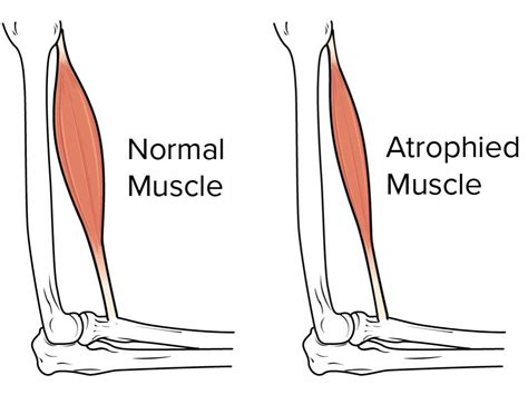 What deficiency causes muscle atrophy?