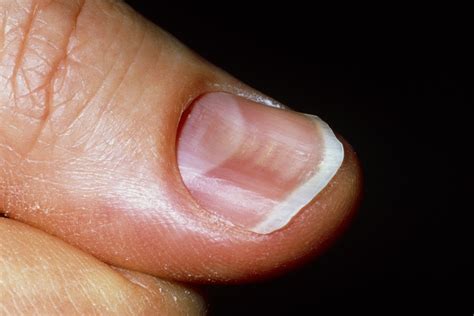 What deficiency causes straight lines in nails?