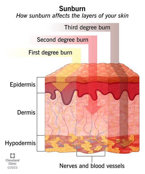 What degree is my sunburn?