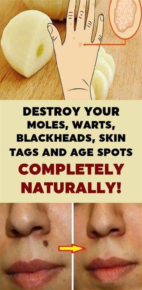 What destroys skin tags?