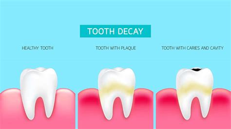 What destroys tooth decay?