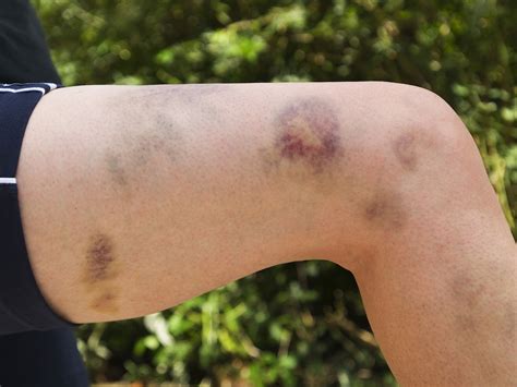 What disease causes skin to bruise easily?