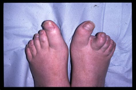 What disease starts in your feet?