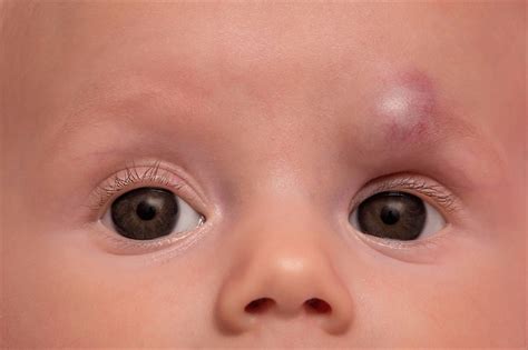 What diseases are associated with birthmarks?