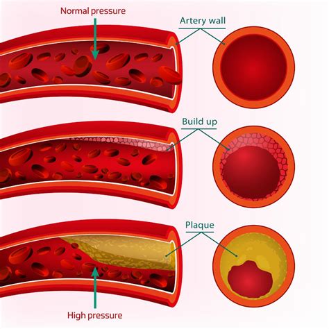 What dissolves artery plaque?