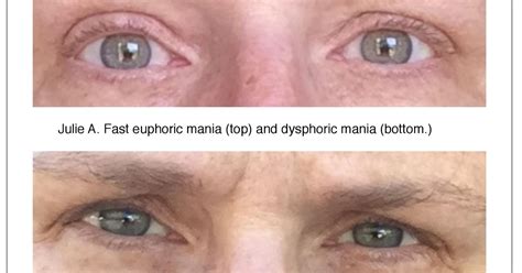 What do bipolar eyes look like?